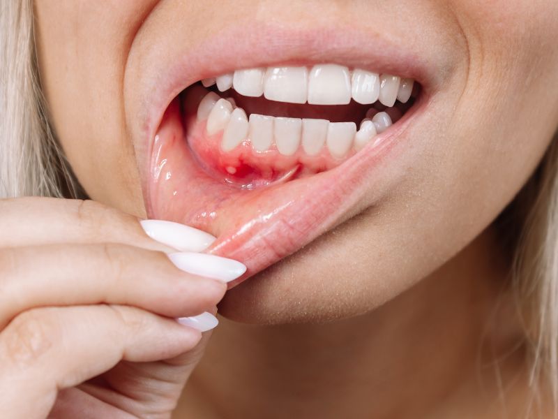 fases de la enfermedad periodontal foto